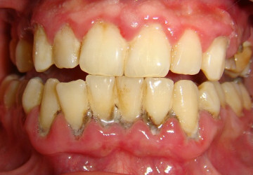 [Cẩm nang sức khỏe] Lấy cao răng có ảnh hưởng gì không?