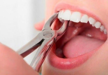 Tại sao cần phải nhổ răng?