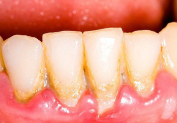 Chân răng có mủ và triệu chứng của bệnh gì?