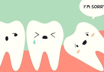 Răng khôn và cách điều trị