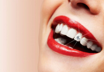 Có nên làm răng đính kim cương? – Lời khuyên từ nha sĩ