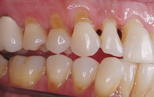 nguyên nhân gây viêm tủy răng 2