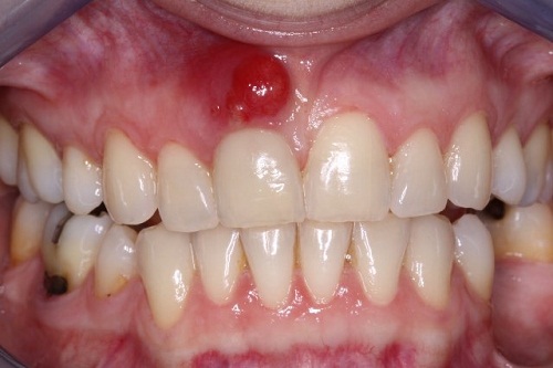 viêm tủy răng có nguy hiểm không 2