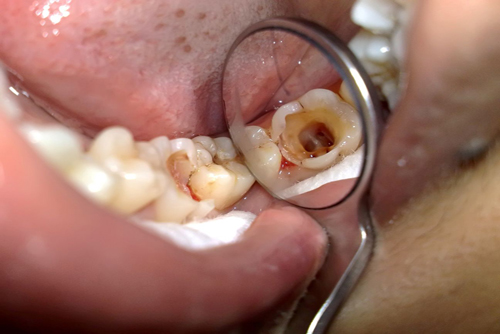 bệnh nướu răng 3