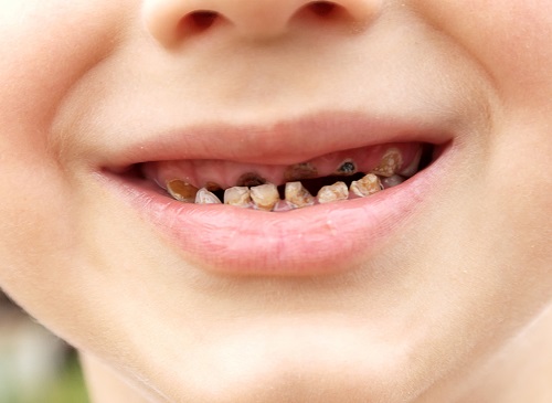 bệnh sâu răng ở trẻ em