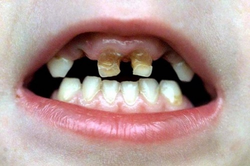 viêm nướu răng ở trẻ em 3