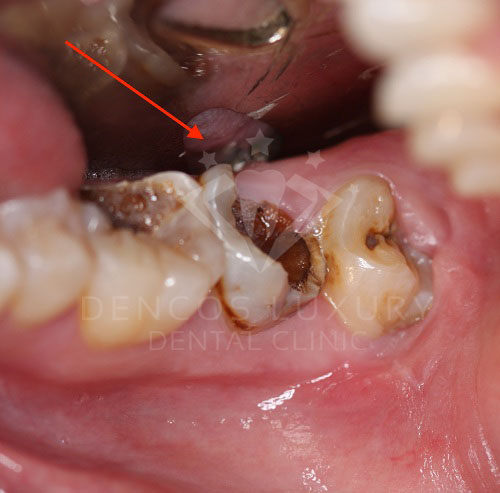 Nhận biết viêm tủy răng và cách điều trị 2