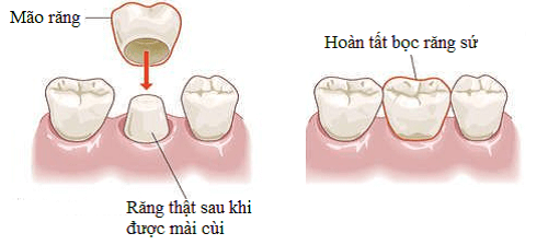 bọc răng sứ thẩm mỹ