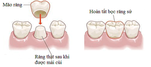 quy trình làm răng sứ