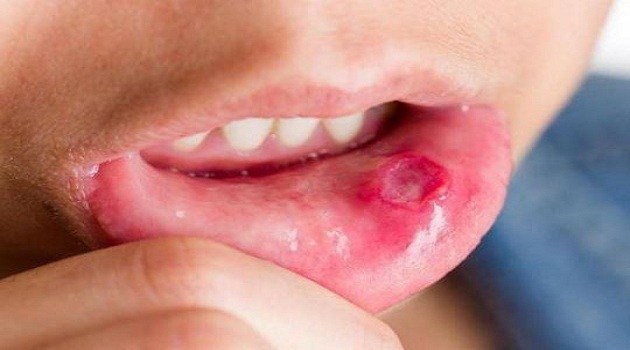 cách trị bệnh lở miệng