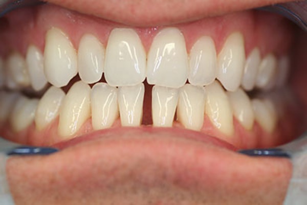 Cách khắc phục răng thưa 
