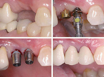 cấy răng implant