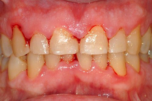 Trị bệnh viêm nướu răng 