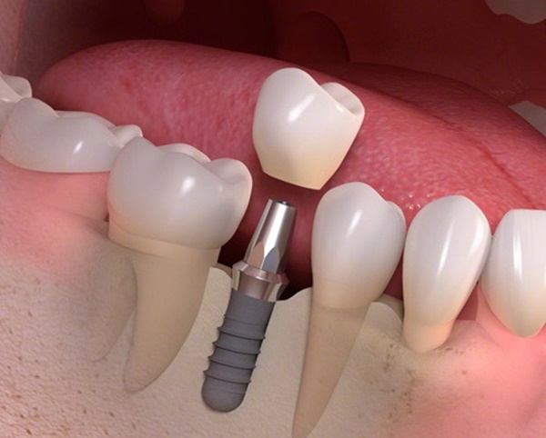 Có nên trồng răng implant 