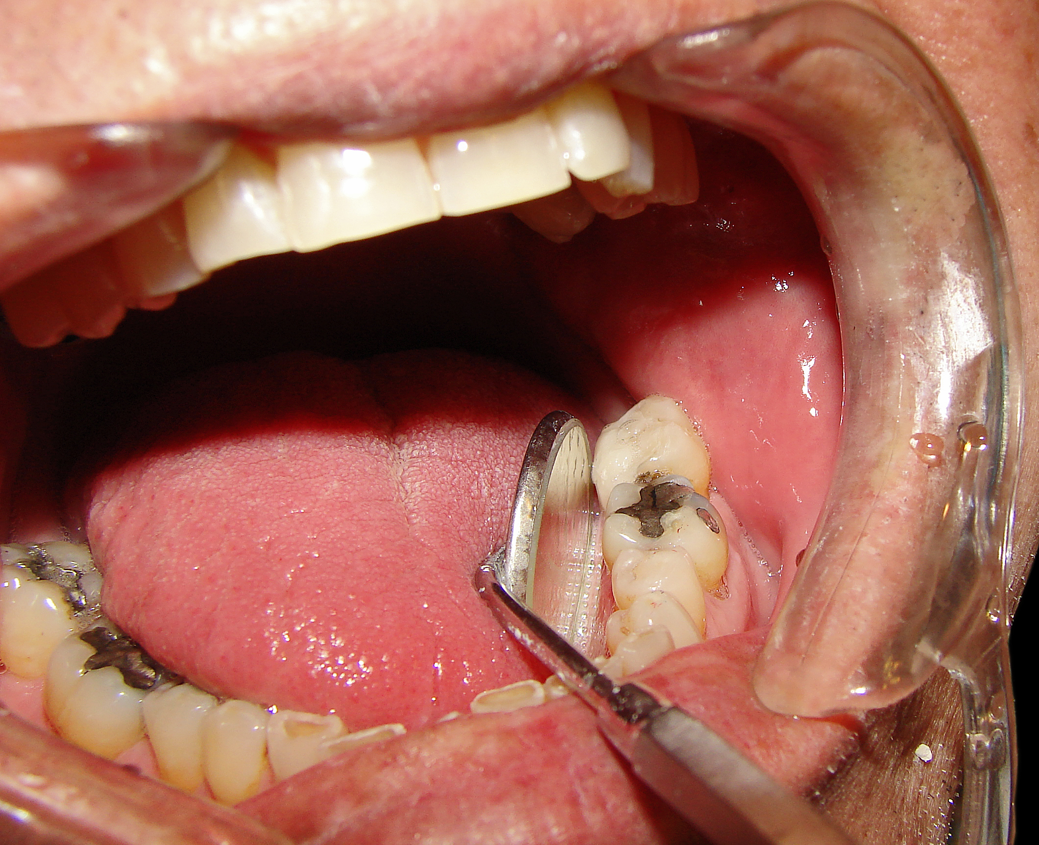 răng hàm lung lay
