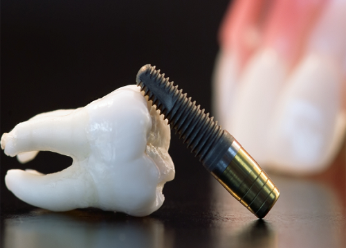 Trồng răng implant có nguy hiểm không