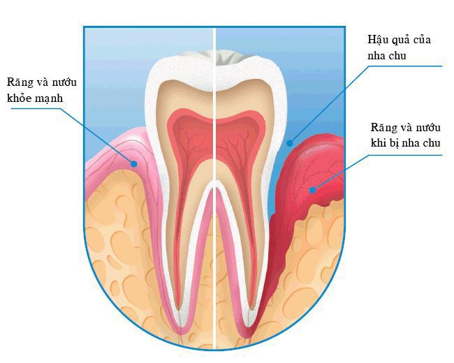 Chảy máu nướu răng là bệnh gì?