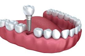 làm răng implant có đau không