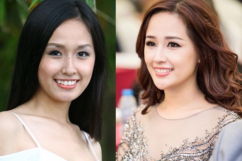 <center>Hoa hậu Mai Phương Thúy dẹp hơn sau khi niềng răng<center>