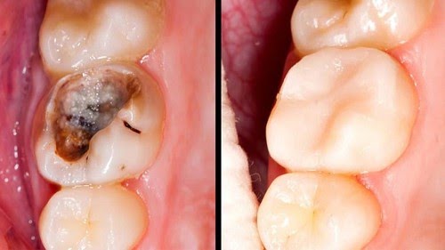 Cơ cấu xuất hiện sâu răng từ việc ăn uống