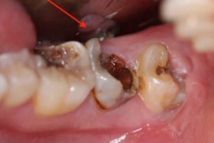 Ảnh hưởng của răng hỏng tới sức khỏe