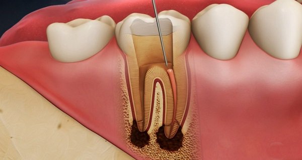 Tìm hiểu điều trị tủy răng