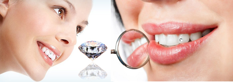 Quy trình đính răng kim cương