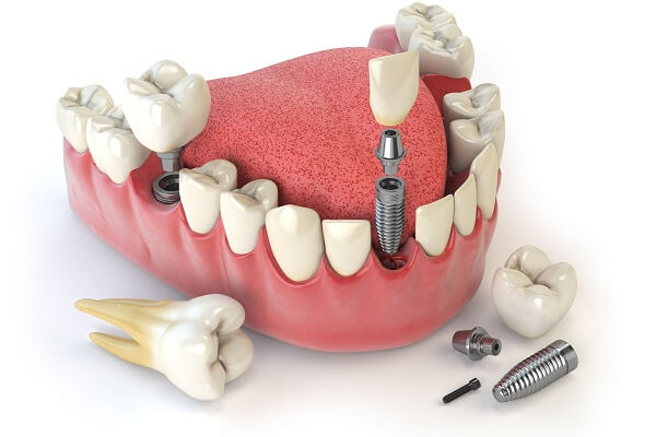 Trồng răng implant 