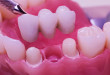 Thông tin chọn lọc từ A – Z về cầu răng sứ cho người làm răng