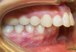 Bạn đã biết nguyên nhân gây răng vẩu và cách khắc phục chưa?