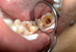 Chữa tủy răng có đau không? Tư vấn từ chuyên gia