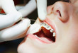 Chuyên gia giải đáp: Niềng răng 1 hàm có được không?