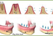 Những điều chuyên gia nói với bạn về tiêu xương răng là gì?