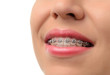 Niềng răng là gì? Phương pháp và quy trình chi tiết