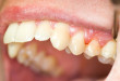 Cảnh báo bệnh nướu răng ai cũng dễ có thể gặp phải