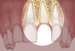 Vì sao nên ghép xương răng trước khi trồng răng Implant?