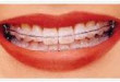 Niềng răng và những lưu ý cần thiết khi niềng răng