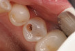 Bác sĩ tư vấn: Răng hàm sâu có nên nhổ không?