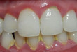 Top 5 cách lấy cao răng tại nhà hiệu quả mà không tốn một xu