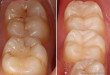 Trám răng sâu liệu đây có phải là giải pháp tốt nhất để trị bệnh sâu răng?