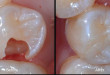 Trám răng sâu – Nên hay không? Cách trị sâu răng