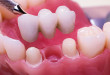 Làm cầu răng như thế nào? – Chi tiết kĩ thuật & các bước thực hiện