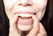 Răng hô nhẹ dùng biện pháp nào hiệu quả nhất