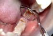 Bạn nên biết nhổ răng hàm có đau không trước khi quyết định nhổ răng