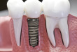 Đối tượng nào được cấy ghép răng implant – Tin nha khoa