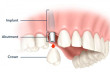 Trồng răng implant có đau không? Và những lưu ý khi trồng răng implant