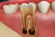 Một loạt câu hỏi liên quan đến điều trị tủy răng như thế nào?