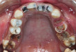 Bị sâu chân răng có nên nhổ hay không?