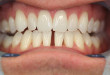 Thế nào là răng thưa? Cách điều trị răng thưa triệt để nhất 2017