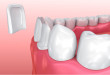 Bọc răng hay trám răng sẽ tốt hơn khi răng sâu?